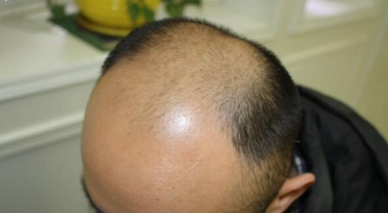 头发少，能用别人的毛囊或体毛来做发际线植发手术吗？（不要告诉别人）- 新麦盛网(图1)