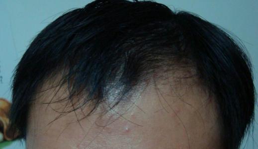 发际线植发一般要多长时间，（发际线植发可以维持多久呢）-  新麦盛网(图1)